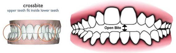 crosstbite vs openbite