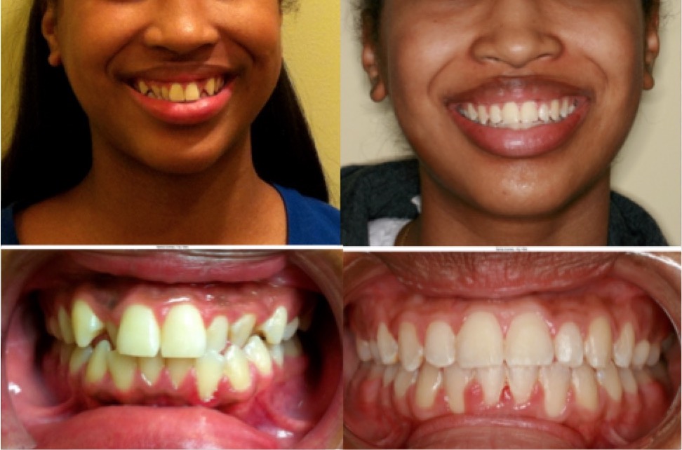 Brooklyn Orthodontics Patient Results Before & After